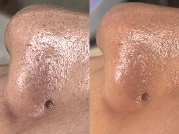 エミナル(Eminal)/◆毛穴フルコース　1回