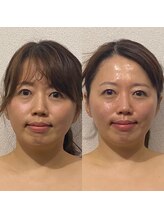 ラクーン 武蔵小杉(raccoon)/インディバフェイシャルで育肌♪