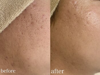 ホワイトアクア 北千住店(WHITE AQUA)/ハーブピーリング3ヶ月後の変化