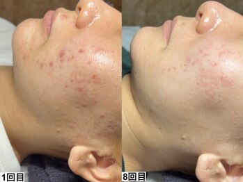 アンドミー 心斎橋店(&me)/ハーブピーリング【ニキビケア】