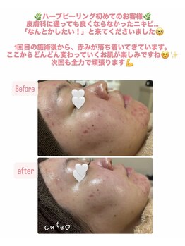 ココ(COCO)/ニキビ肌、さようなら(^ ^)