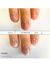 ビンタン(Bintang)/深爪矯正/自爪育成集中コース