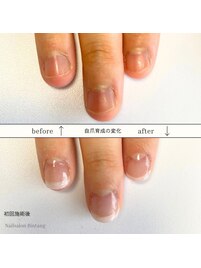 深爪矯正/自爪育成集中コース