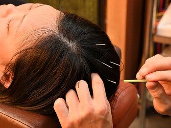 ほぐしてコリとる/頭の鍼で脳をリフレッシュ