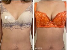 美人バスト 新潟店/ 【バストアップ★育乳】症例