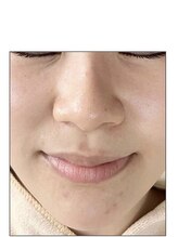 ノーブル 新宿南口(NOBLE)/ハーブピーリング専門