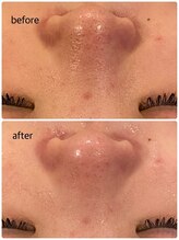 うつくし痩身 美サロン ゼットワン(Z-ONE)/フェイシャル　カーボキシーケア