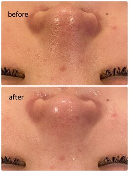 うつくし痩身 美サロン ゼットワン(Z-ONE)/フェイシャル　カーボキシーケア