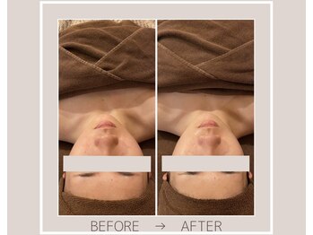 ミルトゥ(myrte)/Before→After ララピール