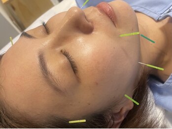 ビューティースタジオ フク(beauty studio fuku)の写真/【お顔のたるみ改善、ハリ・弾力のあるお肌へ!】当店人気No. 1美容鍼で速攻結果出し◎最強エイジングケア！