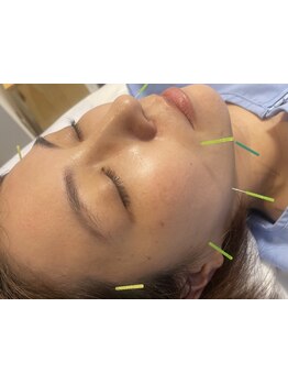 鍼灸施術を受けたい