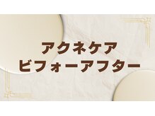 ビエル(Bielle)/赤みざらつき根本アクネケア