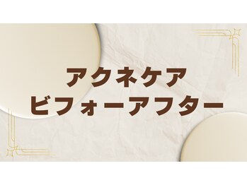 ビエル(Bielle)/赤みざらつき根本アクネケア