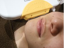 メンズ スリーク(Men's SLEEK)/顔脱毛