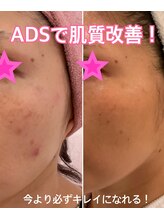 トータルビューティーサロン 凛/#シミ改善