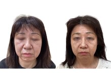 けいのき鍼灸整骨院/美容鍼/ほうれい線/鍼/小顔/毛穴