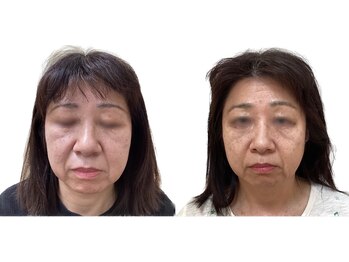 けいのき鍼灸整骨院/美容鍼/ほうれい線/鍼/小顔/毛穴