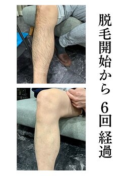 アンジェリーナ/すね毛/6回経過/都度払い