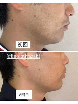 リノ(LINO)/LINOのヒゲ脱毛