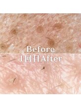 ミニョスキンラボ/W幹細胞ハーブピーリング1回