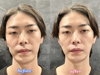 アモーラ(Amora)/エクソソーム導入