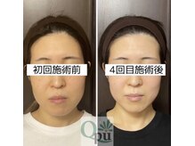 キュープ 相模原淵野辺店(Qpu)/たった4回で人生で1番小さな顔に