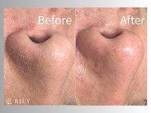 リリー(RILY)/【毛穴洗浄ビフォーアフター】
