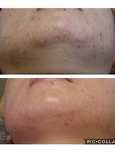 ベビースキン(baby skin)/肌改善