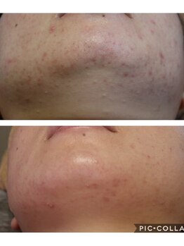 ベビースキン(baby skin)/肌改善