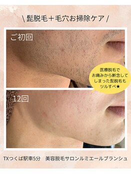 ルミエールブランシュ(Lumiere blanche)/髭脱毛+毛穴ケア+ビタミン導入