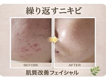 エクラ/大人ニキビ改善