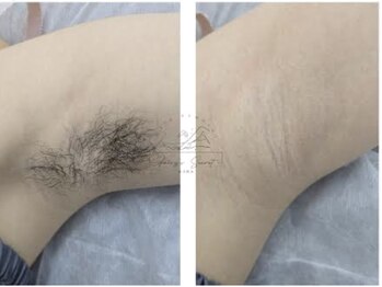 ルルビューティーの写真/脱毛導入キャンペーン価格で顔脱毛1回5000円☆都度払いで安心、化粧ノリUP!