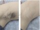 ルルビューティーの写真/脱毛導入キャンペーン価格で顔脱毛1回5000円☆都度払いで安心、化粧ノリUP!
