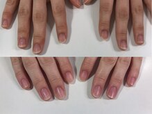エスネイル(S-nail)/深爪矯正/自爪育成