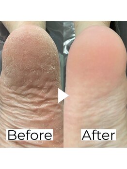 本気の足裏角質除去！