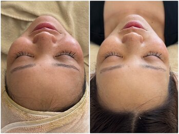 マヴィ 香里園店(MavY.)/施術1回 ノンニードル水光注入