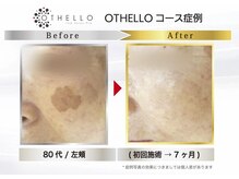 ノーマ(NORMA)/シミケア　ビフォーアフター