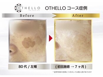 ノーマ(NORMA)/シミケア　ビフォーアフター