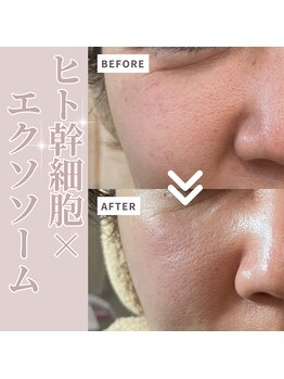 テセラ(Tethere)/ヒト幹細胞×エクソソーム