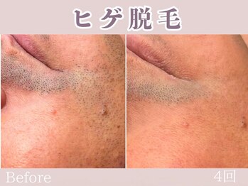 レッド(RED)/髭脱毛