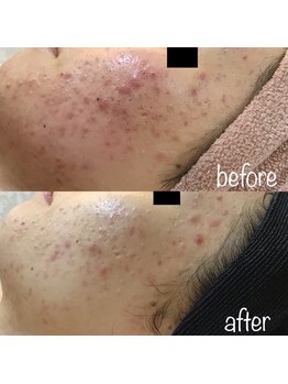 ルリミ(Relimi)/ハーブピーリング　Before After