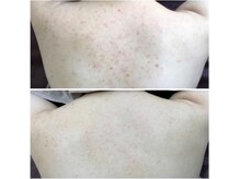 キッカ 梅田天六(Kikka)/背中＊ハーブピーリング