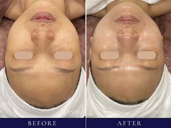 フローラル ビューティー(Floral-Beauty)/【ビフォーアフター】小顔エステ