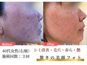 トレース/美顔フォトの効果（40代女性）