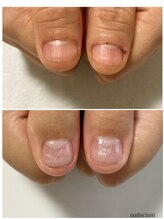 ネイルズシアム/深爪矯正