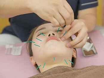 越谷駅前鍼灸整骨院の写真/美容鍼で身体の内側からキレイを目指しませんか?