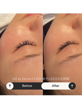 ポピン(POPIN)/白玉酸素管理+赤色LED15分照射