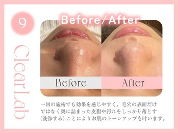 クリアラボ 錦糸町(Clear Lab)/韓国肌管理&毛穴洗浄専門店
