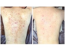 美肌研究所 東京新宿支店/毛孔苔癬・ニキビケアの改善例