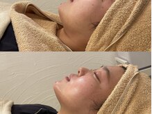 ストリ(STRI)/美容鍼before、after